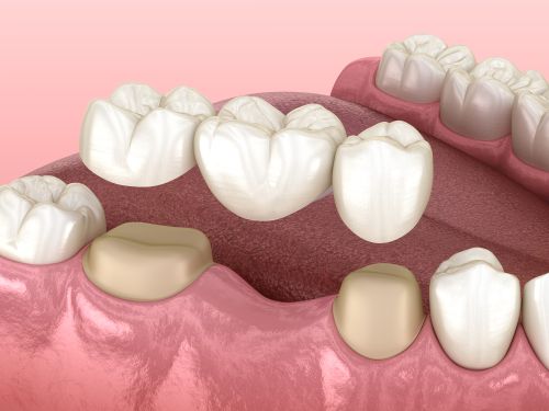 Preparation of supporting teeth for bridge placement